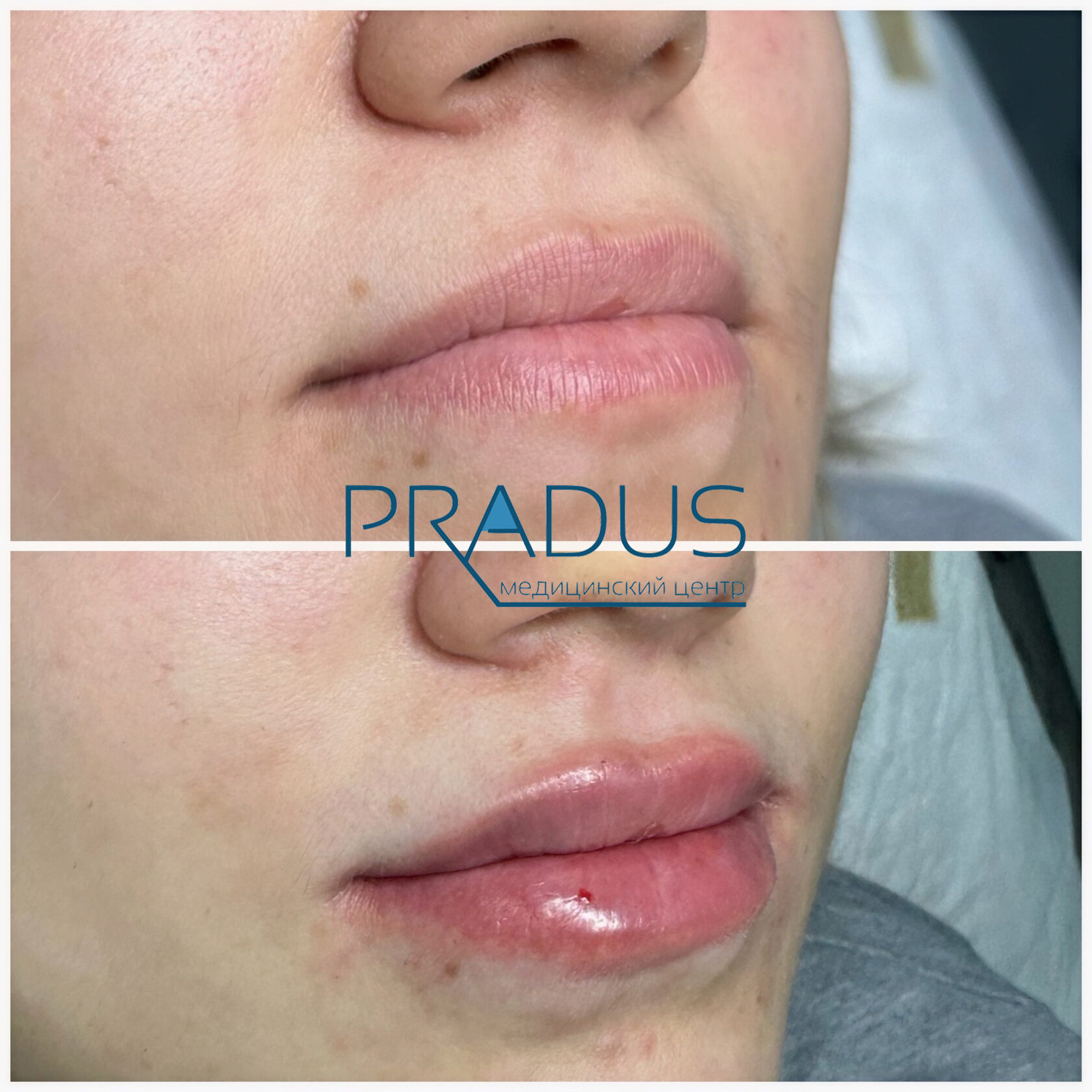До и после контурной пластики губ. PradusCOSMO, Васильевский остров