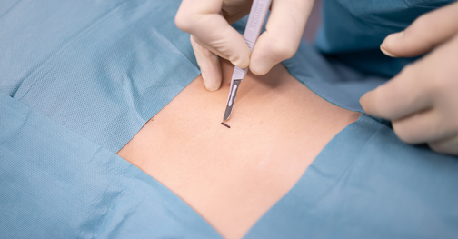 Minimalinvasive Rückenoperation in der Rückenpraxis Seefeld