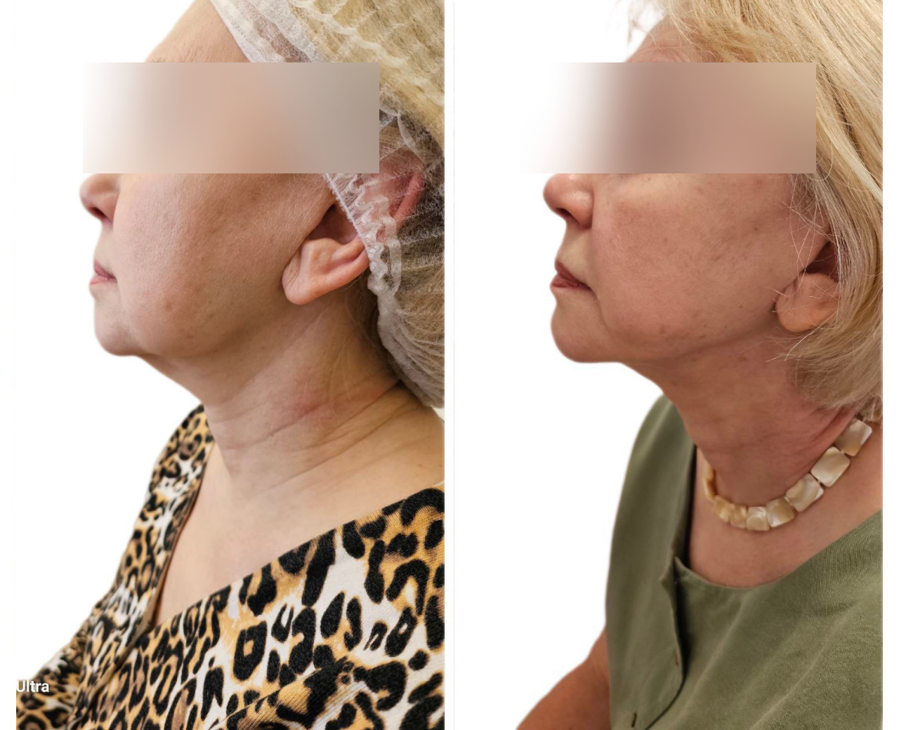 Липоредукция второго подбородка - подтянутый и четкий контур всего за 1 ...