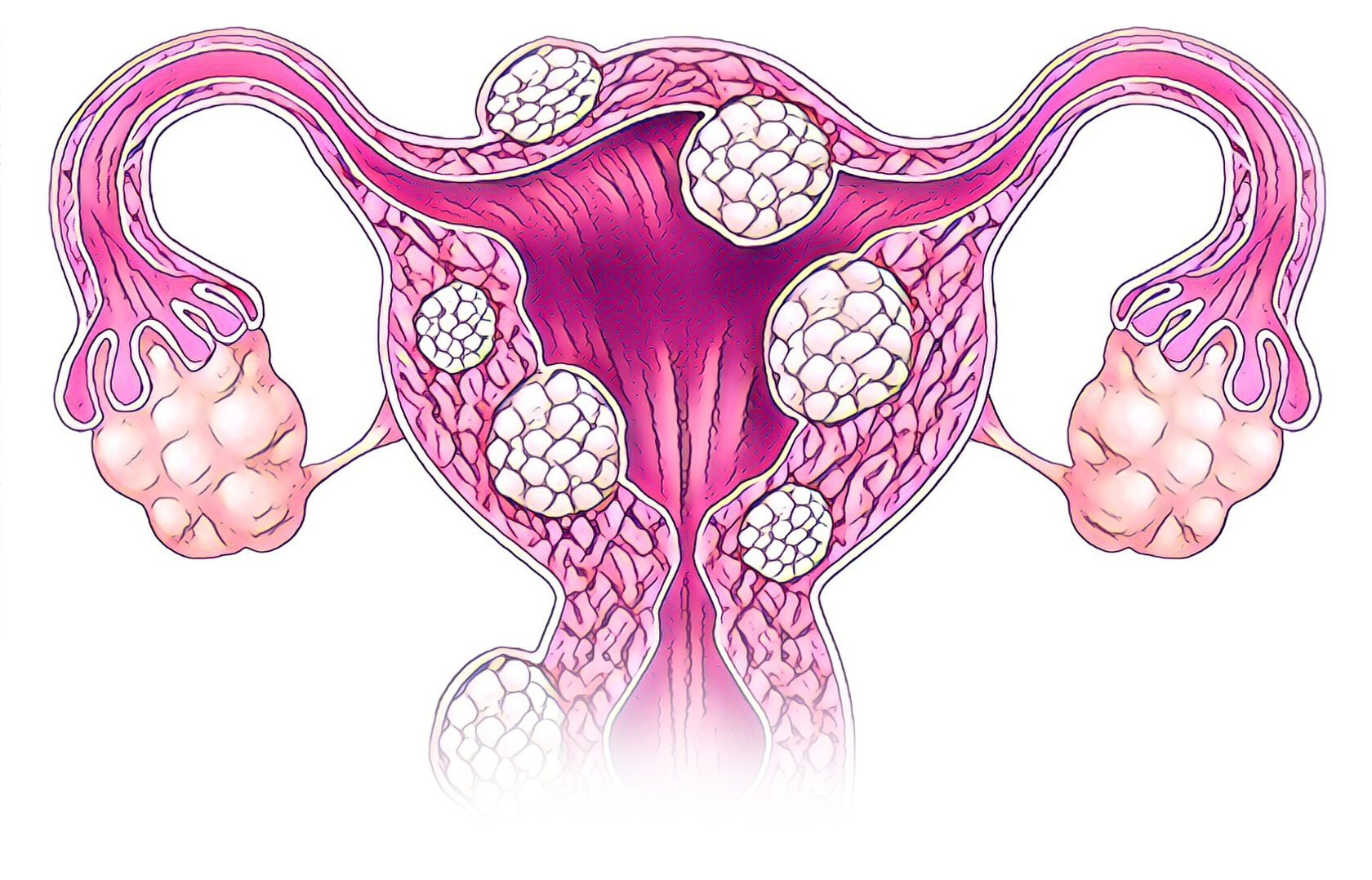 Рак шейки матки - лечение при помощи цитокиногенетической терапии ...