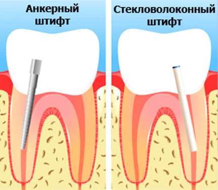 Штифтовой зуб по логану