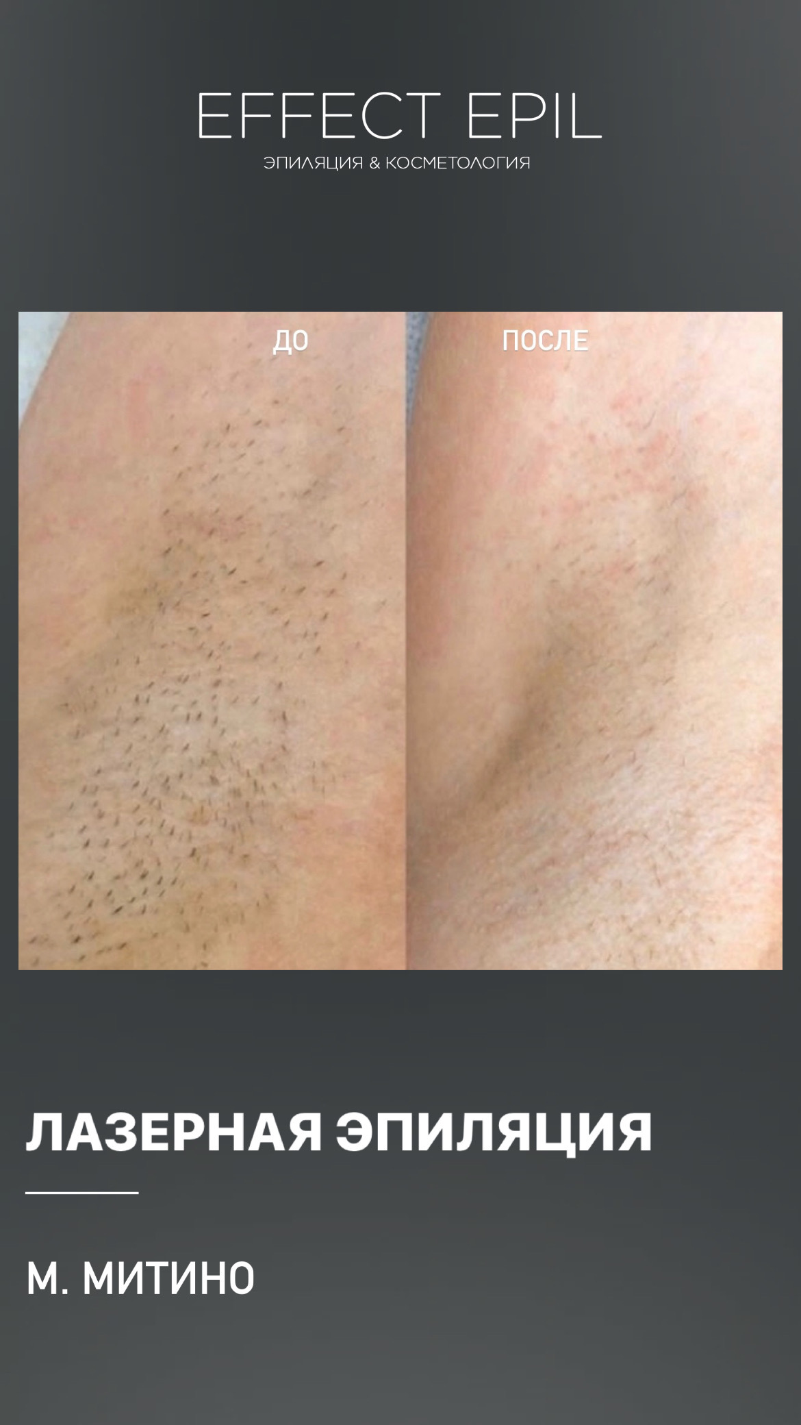 Лазерная эпиляция в Митино и на Пятницком шоссе