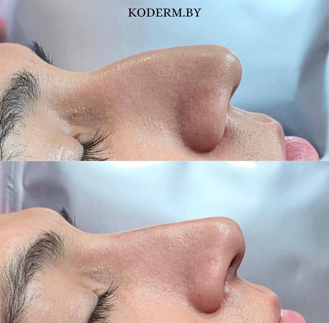 Безоперационная коррекция формы носа, увеличение и контурная пластика губ в Туле в ЦЭМ «Талисия»