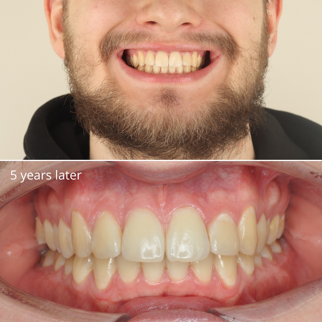 After photo showing a stable, functional result after eight years of retention — photo 3 of 3