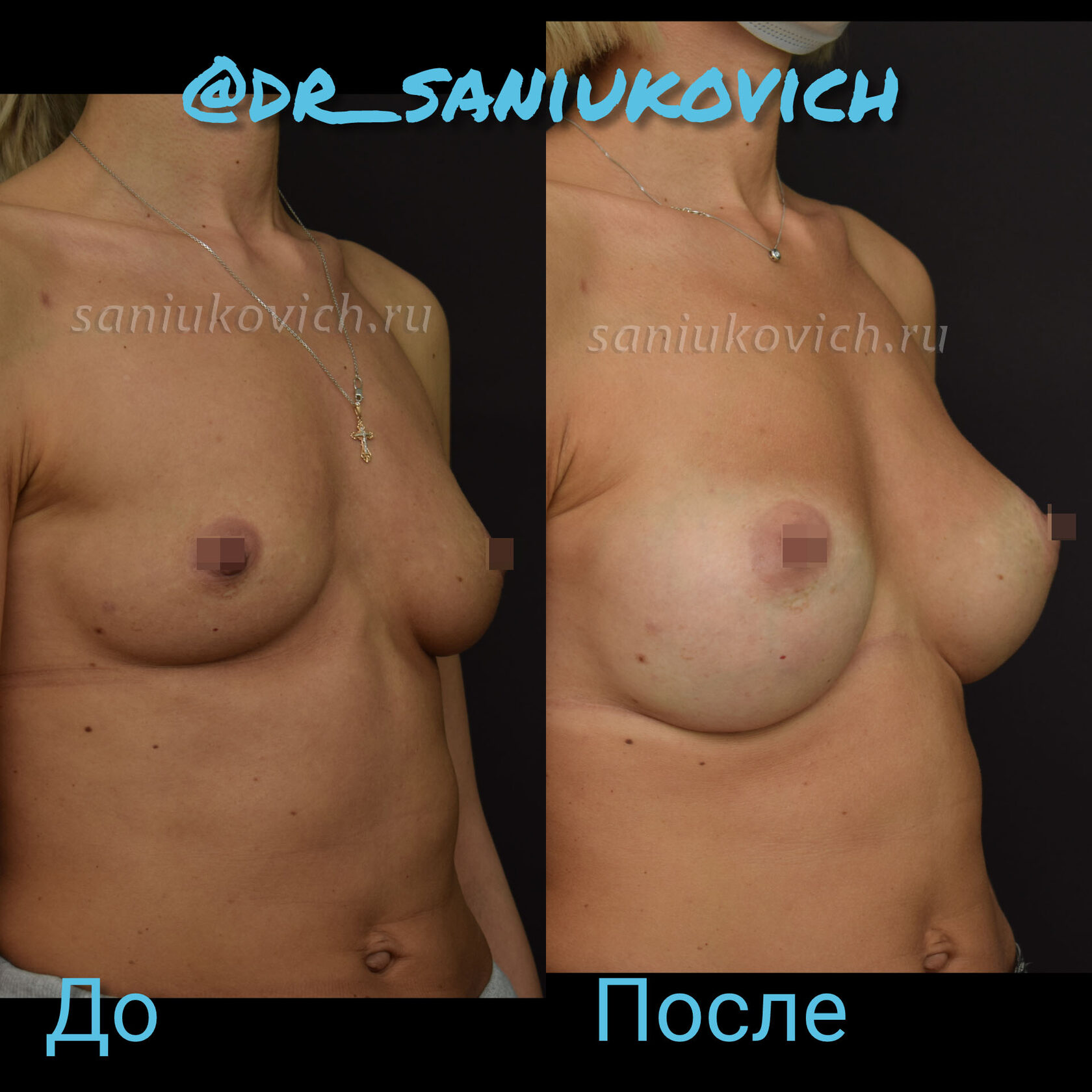 удаление импланта груди у женщин фото 77