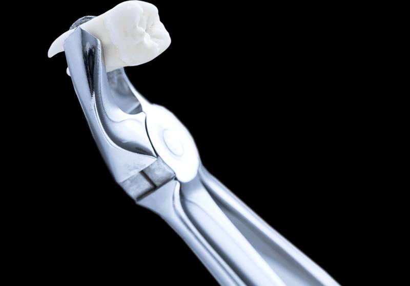 отличие сложного удаления зуба мудрости