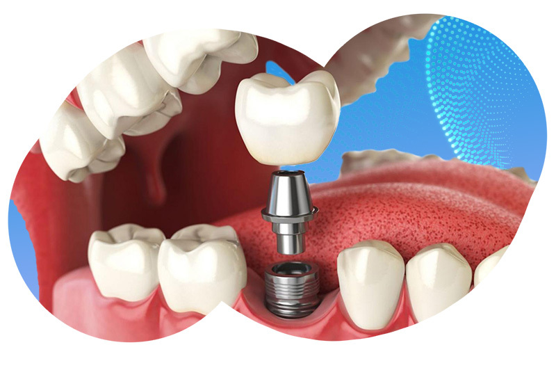 установка импланта