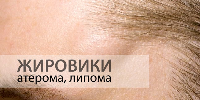 Удаление жировиков (липом) в клинике инновационных медицинских ...