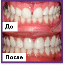 Установка имплантов в Дербенте. Имплантация при отсутствии одного зуба.