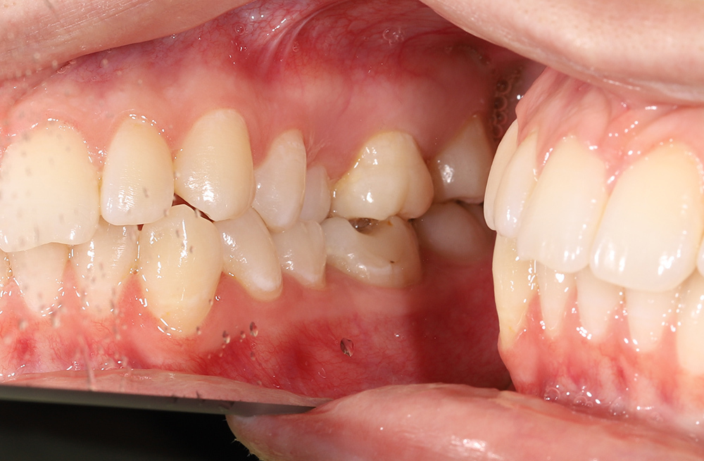 Сохранение жевательного зуба при периодонтите с помощью эндодонтии и коронки из циркония