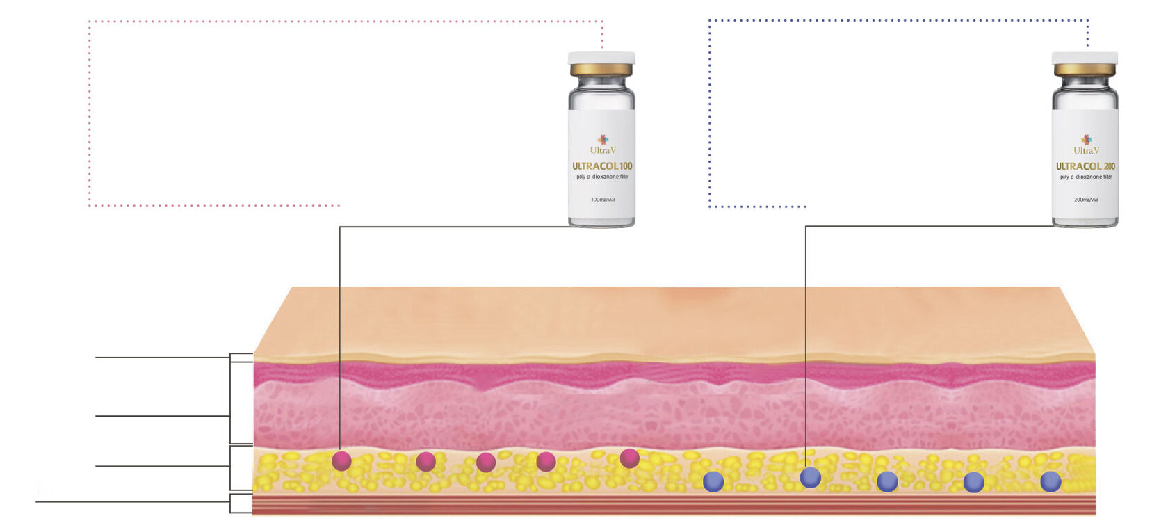 Ultracol - филлер на основе полидиоксанона