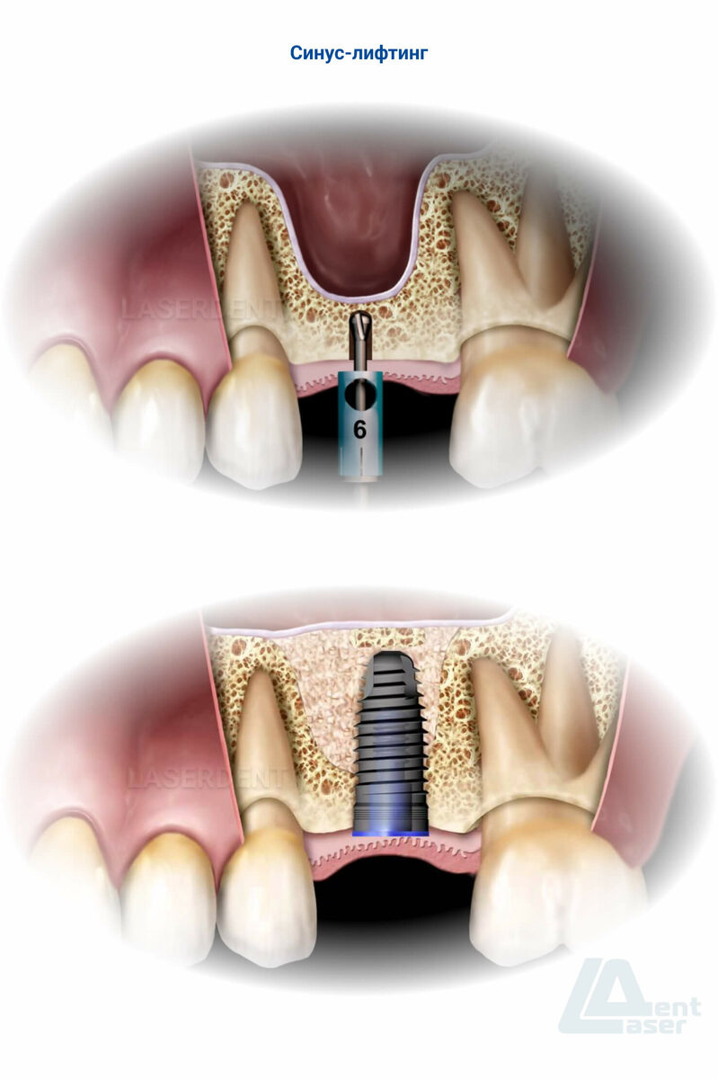 Имплантация зубов в стоматологии Лазердент Хабаровск