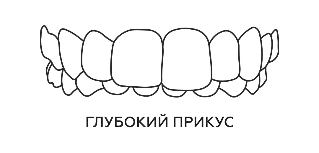 Виды неправильного прикуса