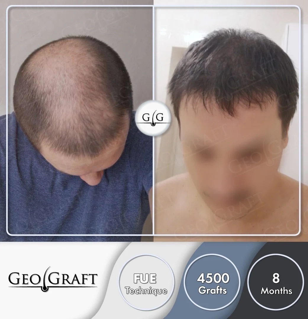 Пересадка волос в Москве. Geograft. Без боли - за один день.