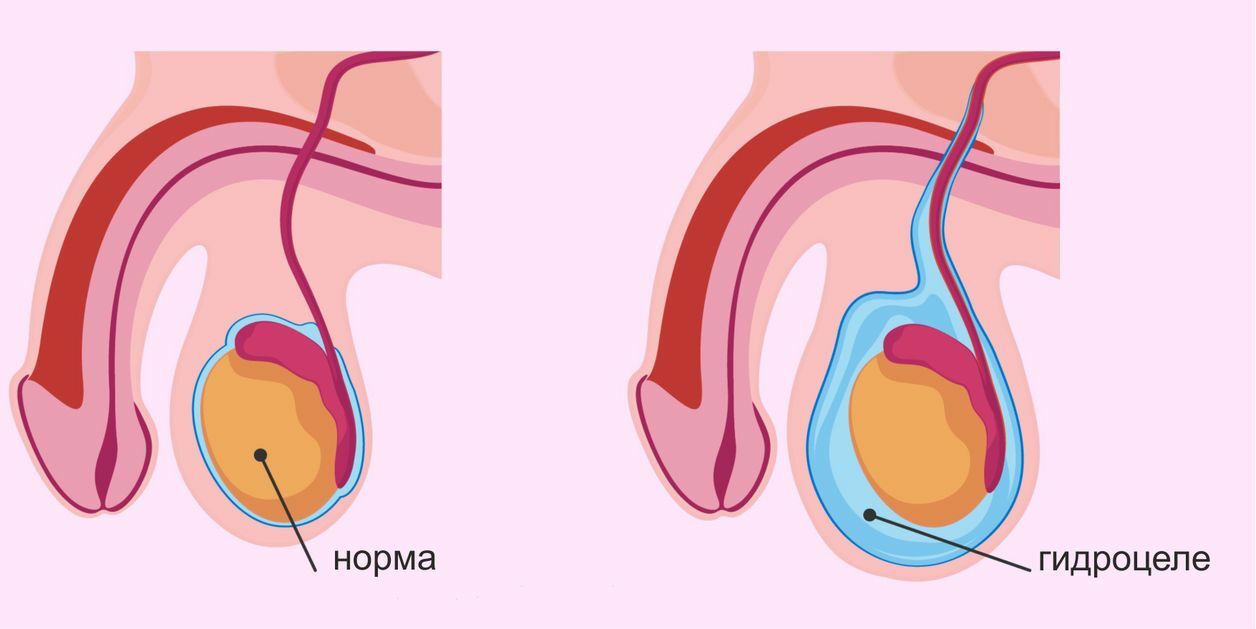 Опухание (увеличение) яичек, мошонки