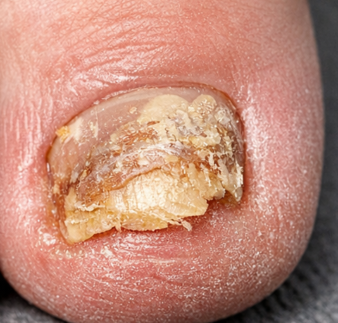 Поражённый грибком ноготь на ноге