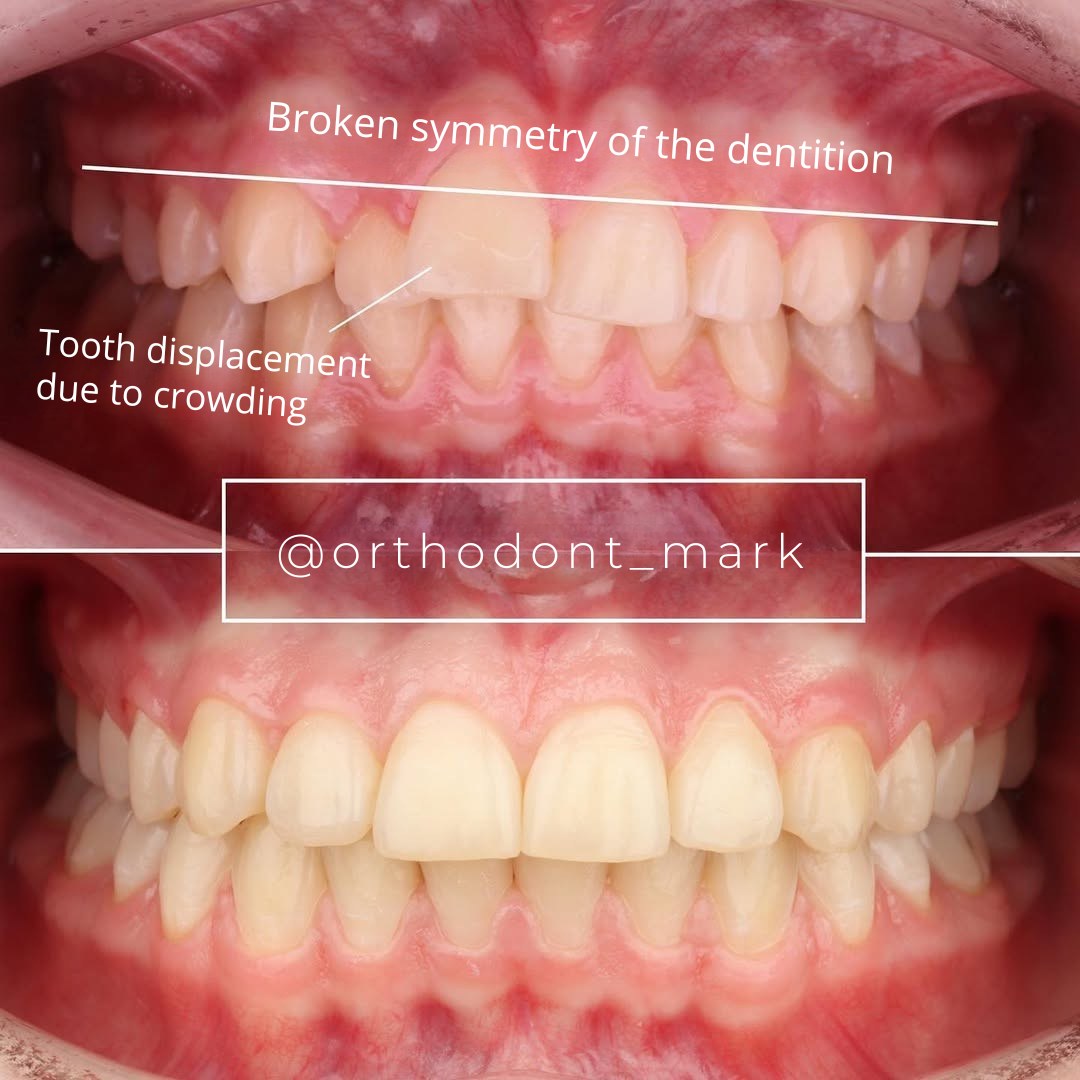 Mid-treatment stage showing progressive alignment and arch development — photo 2 of 3