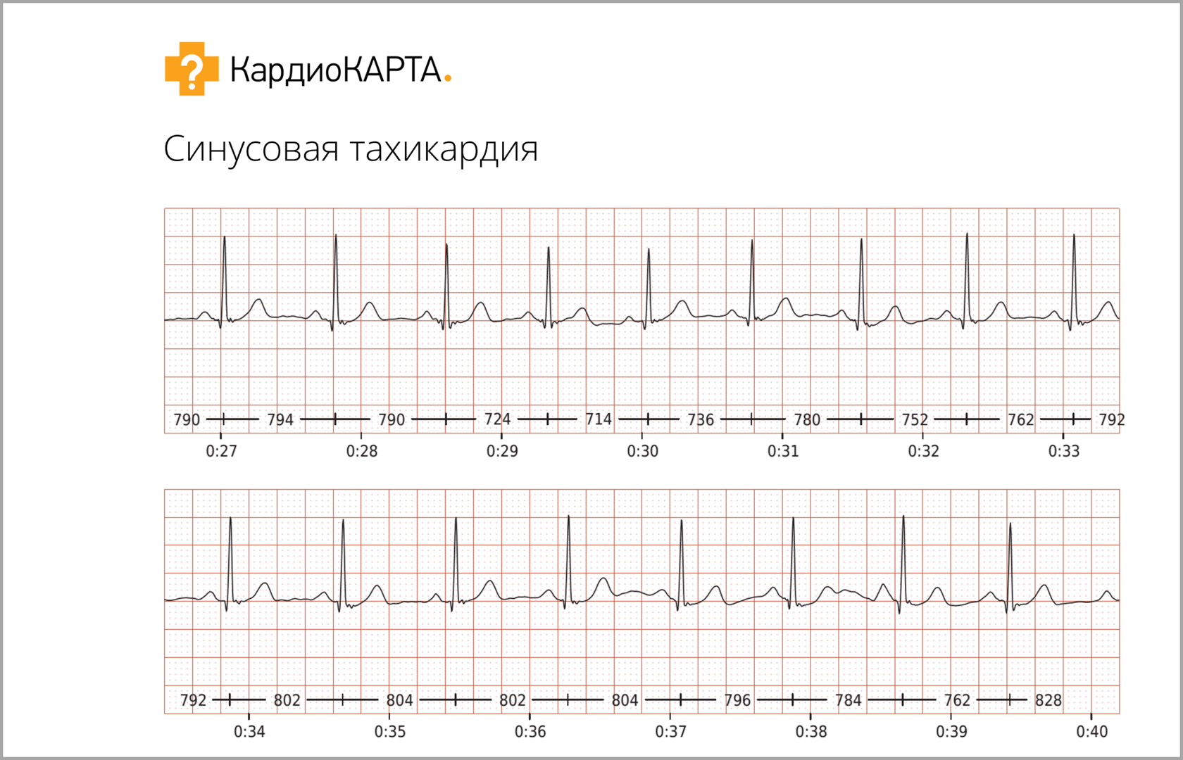 Внезапное сильное сердцебиение: тахикардия, аритмия или не причина для  беспокойства? | КардиоКВАРК