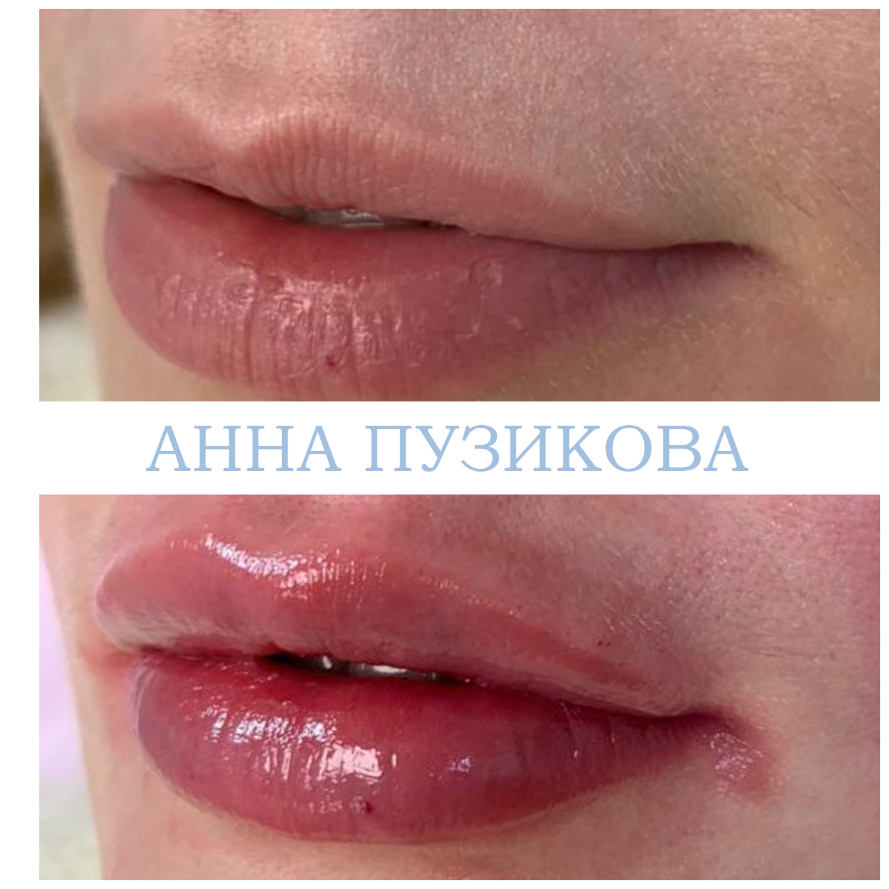 Контурная пластика губ гиалуроновым филлером — естественный результат без утраты пропорций. Косметолог Пузикова Анна Анатольевна, Санкт-Петербург.