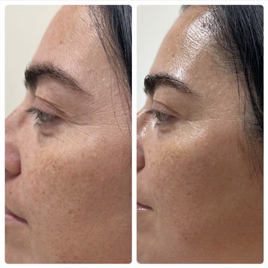 RF Microcurrent before and after face toning results Beauty Studio by Hanna Mount Pleasant SC
