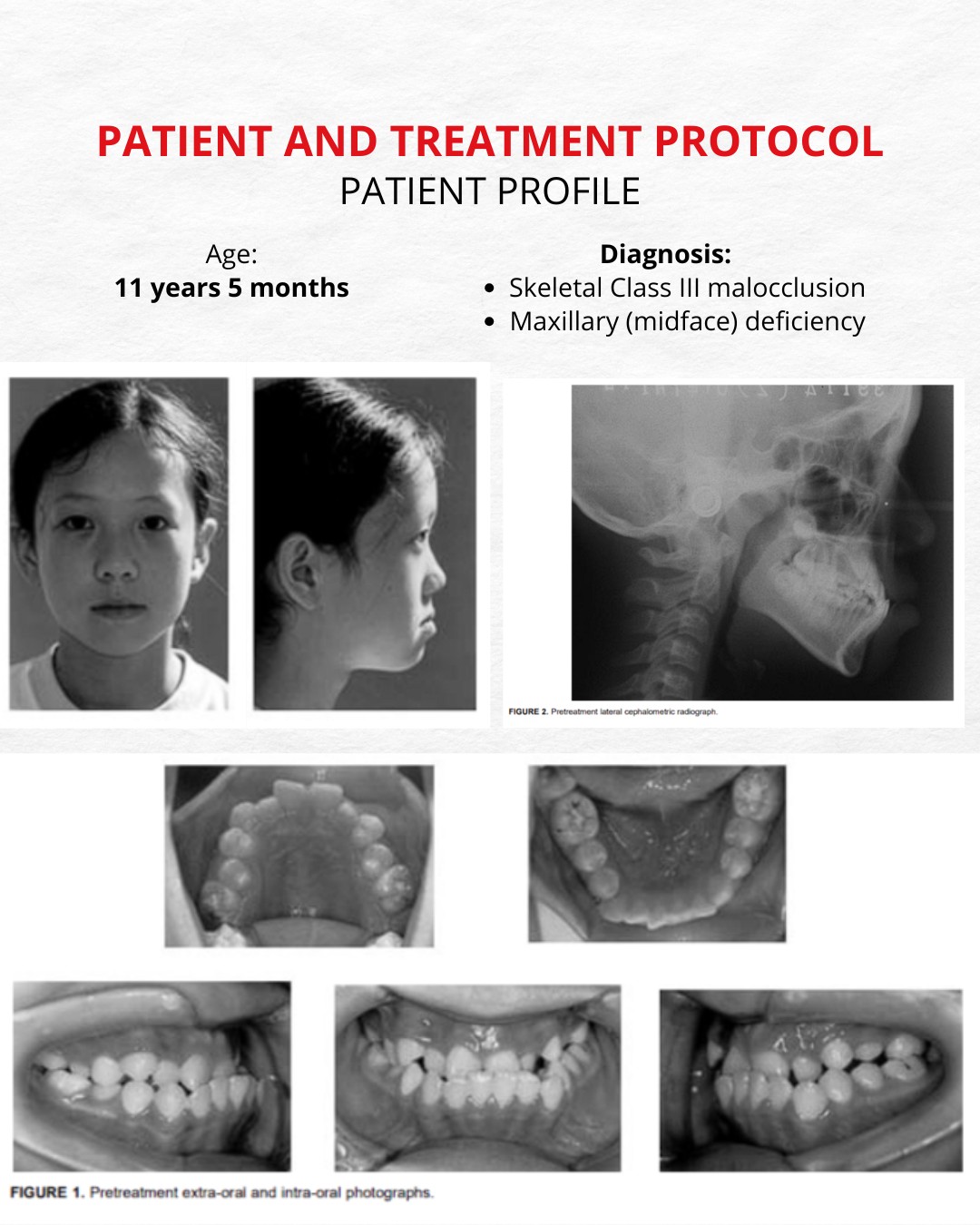 Stage showing continued protraction with minimal dental side effects — photo 5 of 10