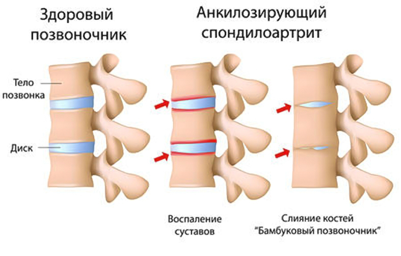 Анкилозирующий спондилоартрит