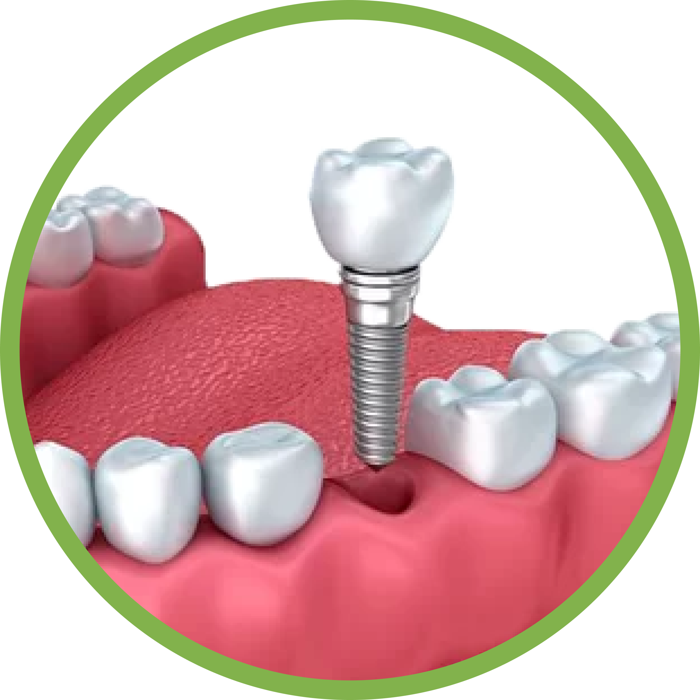 Установка имплантов в Дербенте. Имплантация при отсутствии одного зуба.