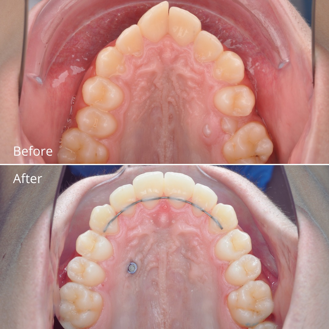 Stage of treatment showing continued alignment of the crowded teeth — photo 3 of 6