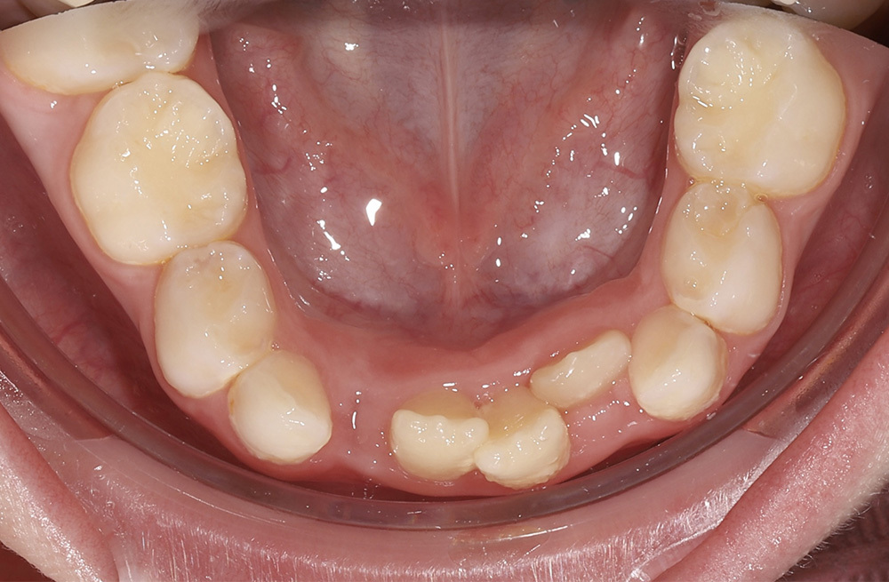 Создание условий для правильного прорезывания постоянных зубов при сужении зубных рядов у ребёнка