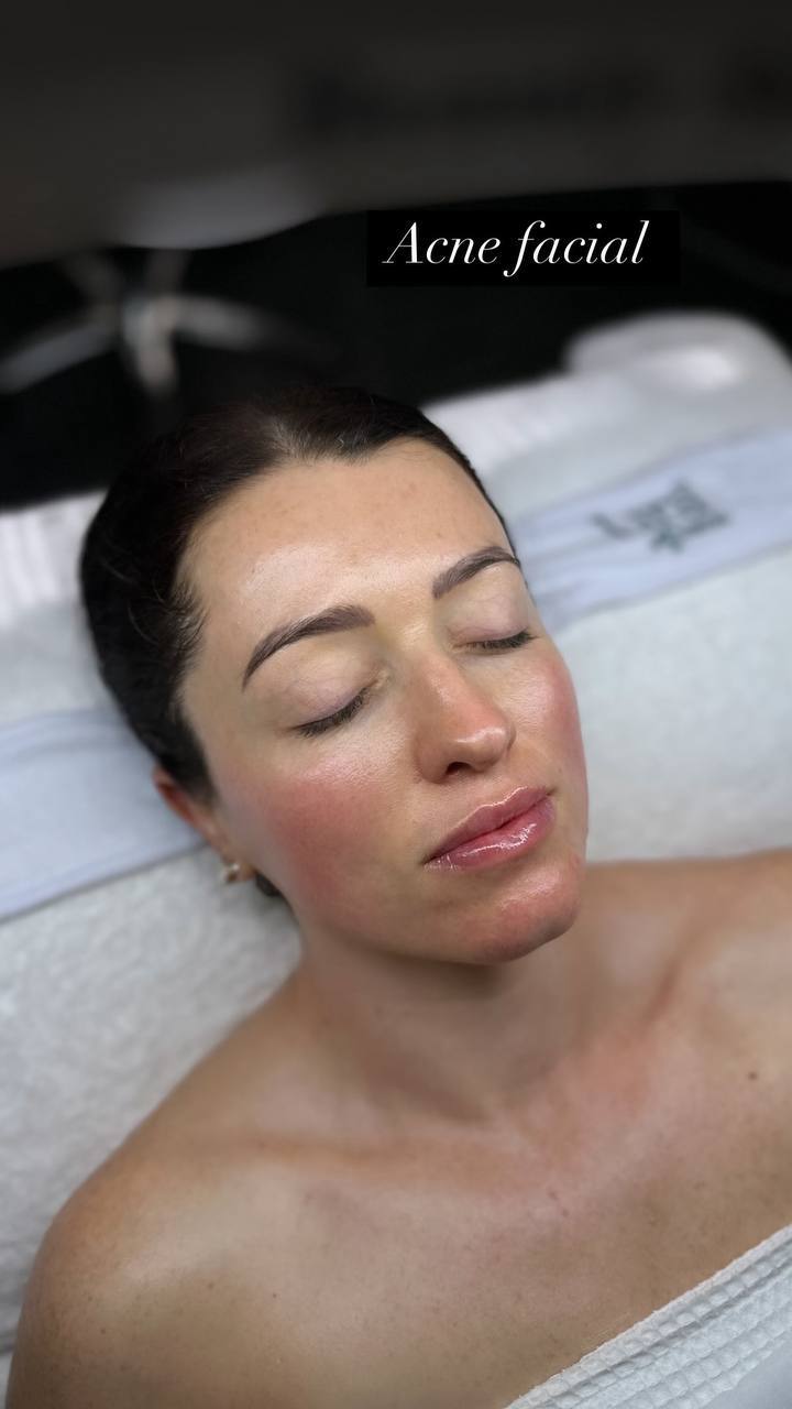 Acne treatment result from a client at Beauty Studio by Hanna in Mount Pleasant, SC