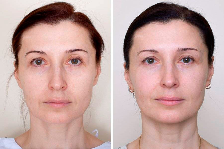 Rf лифтинг лица до после