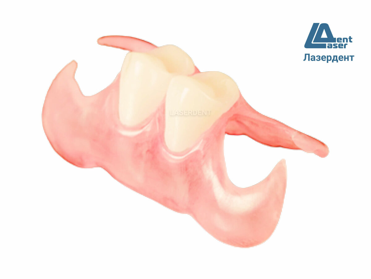 Съемный зубной протез бабочка. Частичный съемный протез бабочка. Протез бабочка в Бийске.