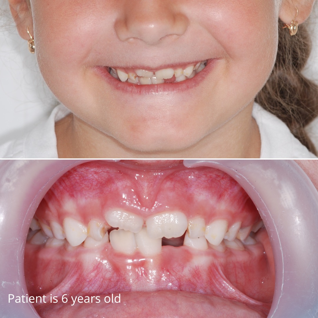View at the start of comprehensive treatment at age 13 with the Damon bracket system — photo 3 of 6
