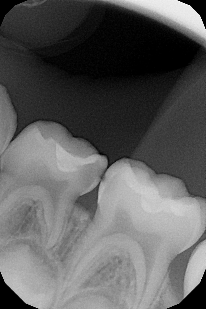 Комплексное восстановление молочных зубов при кариесе и пульпите у ребёнка 4х лет