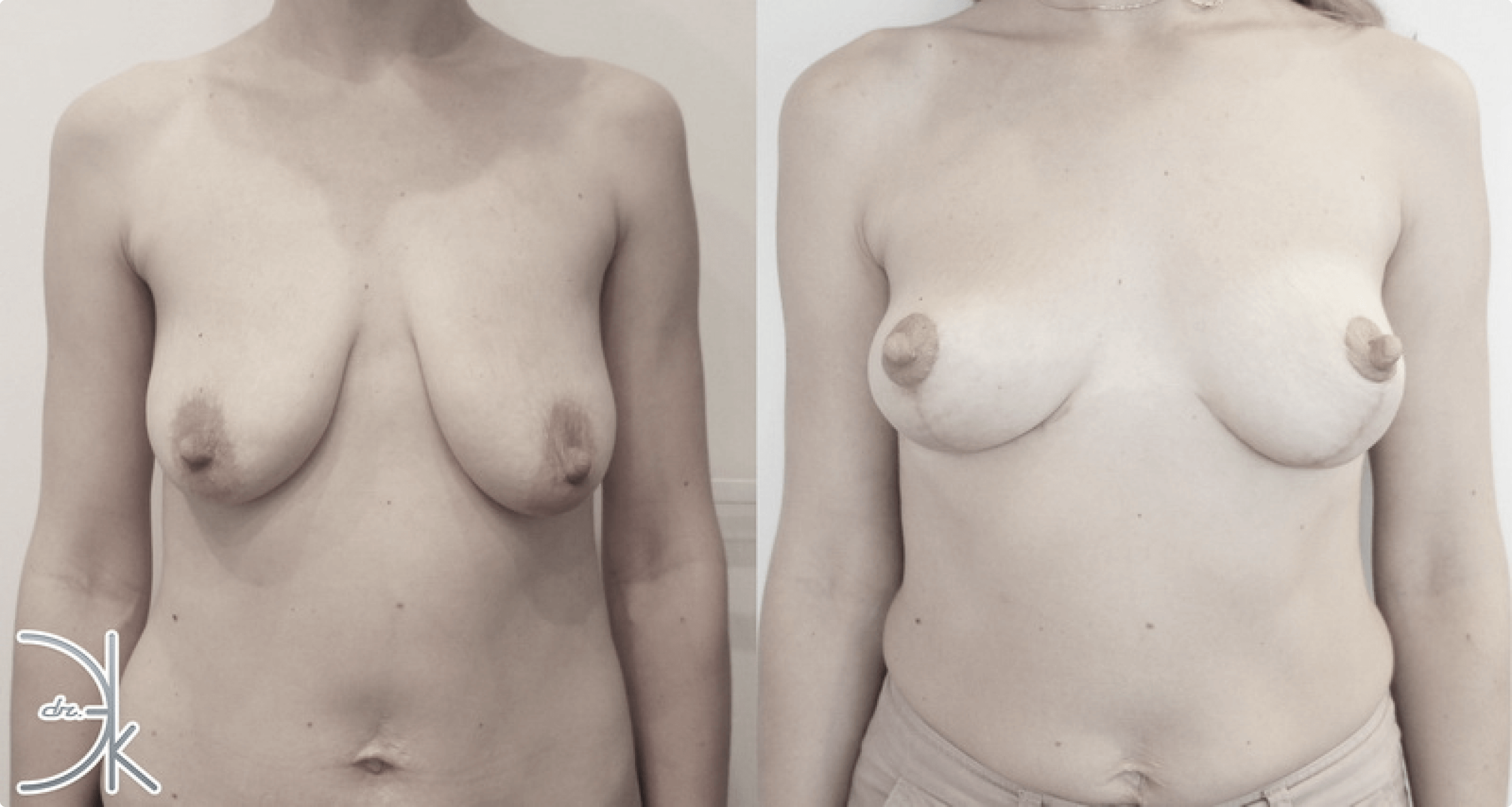 липосакции груди у женщин фото 9