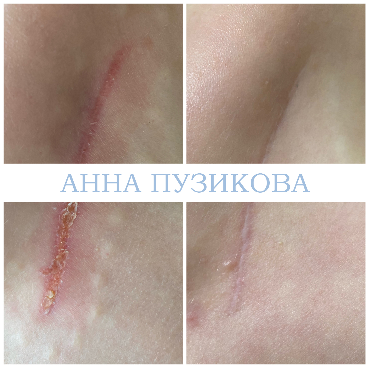 Результат удаления шрама у пациента — косметолог Пузикова Анна Анатольевна, Санкт-Петербург