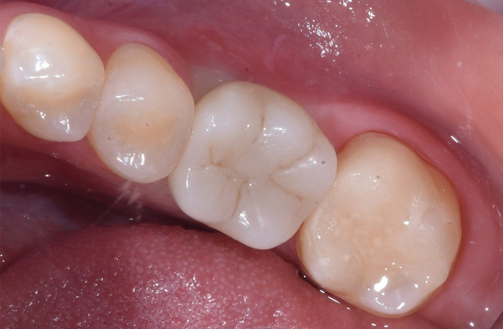 Решение проблемы отсутствующего зуба на нижней челюсти с применением системы Osstem и установкой циркониевой коронки