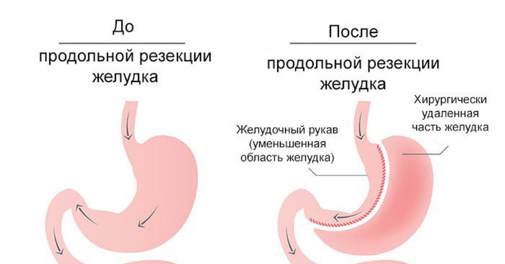 Бариатрическая операция продольная резекция желудка. Рукавная гастропластика желудка. Эндоскопическая рукавная гастропластика. Продольная (рукавная) резекция желудка. Бариатрическая операция на желудке.