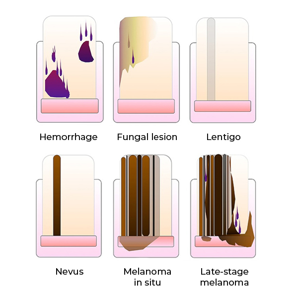 Nail melanoma symptoms, photos, stages
