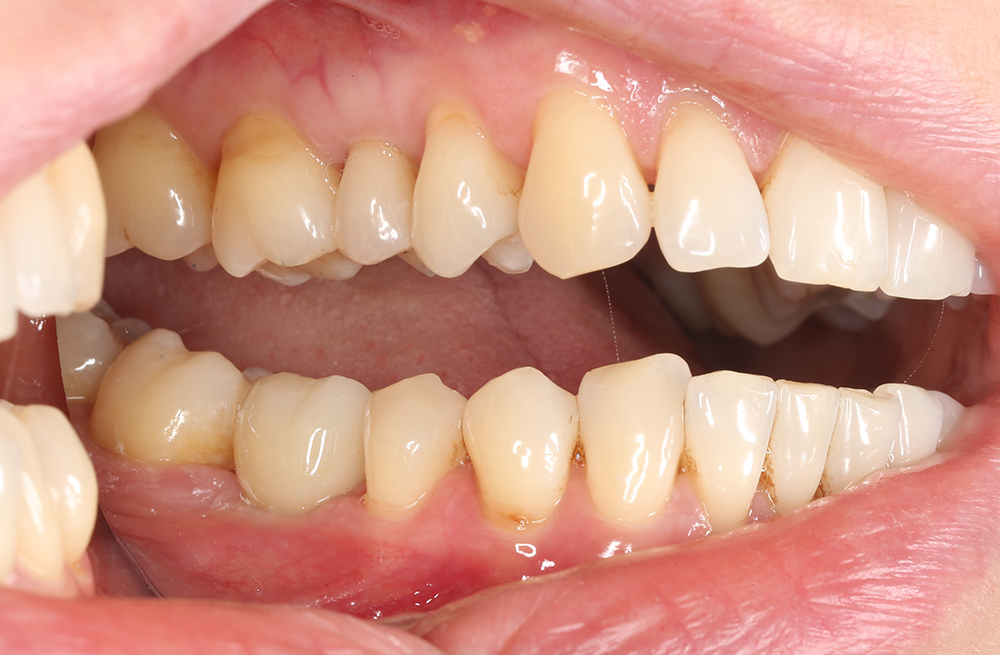 Лечение последствий хронического периодонтита имплантацией и циркониевой реставрацией