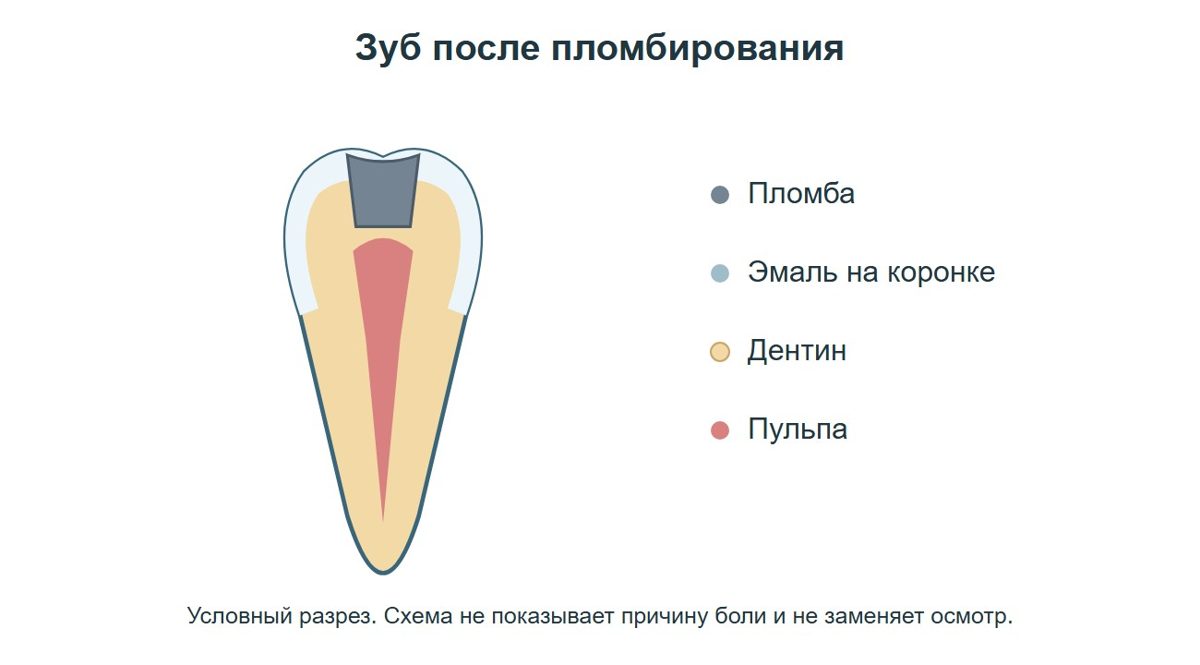 Схема строения зуба после пломбирования кариозной полости