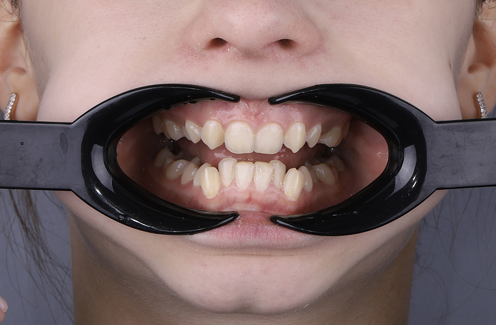 Комплексное ортодонтическое лечение у девушки с множественными нарушениями прикуса на фоне врождённой адентии боковых резцов