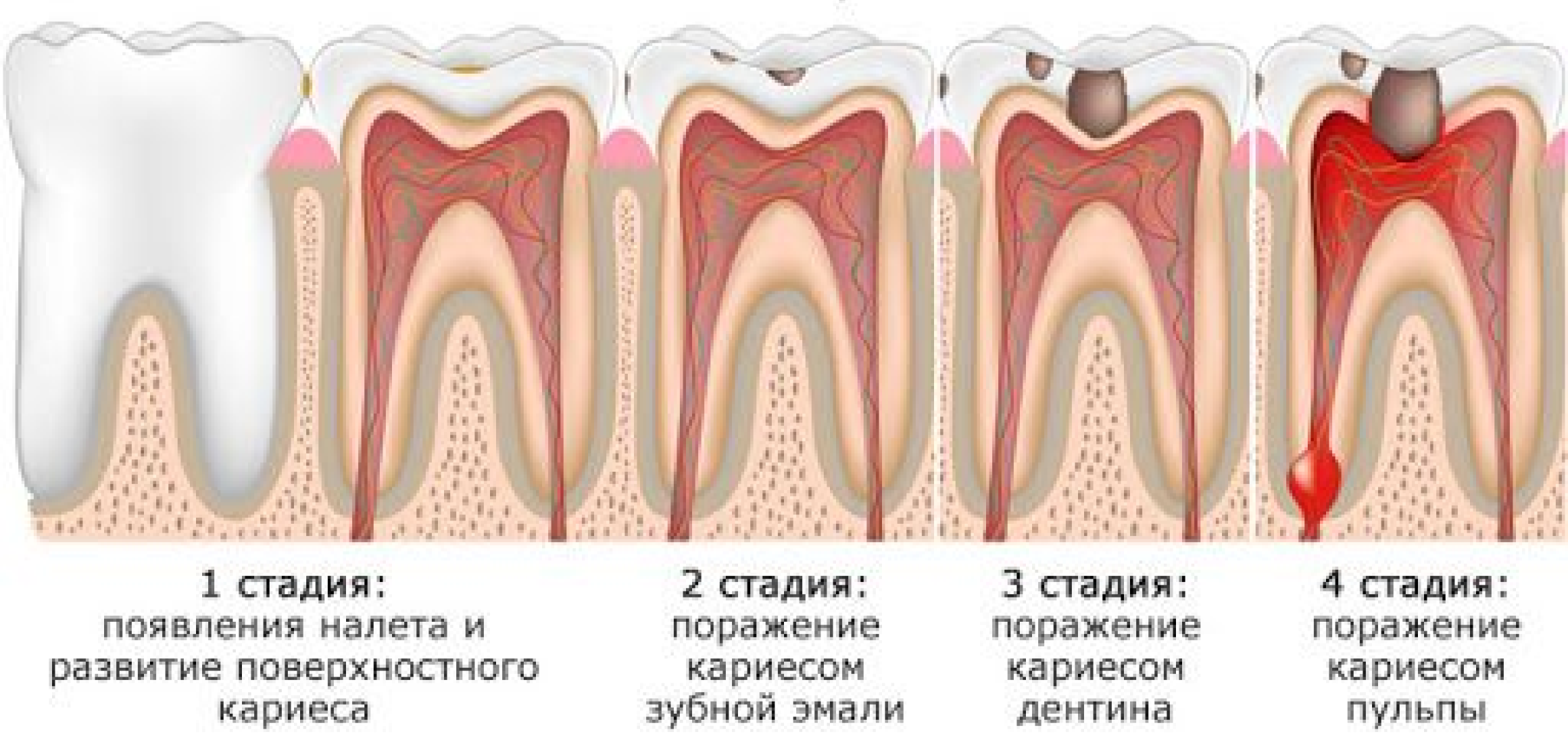 Пульпит Зуба Лечение Цена