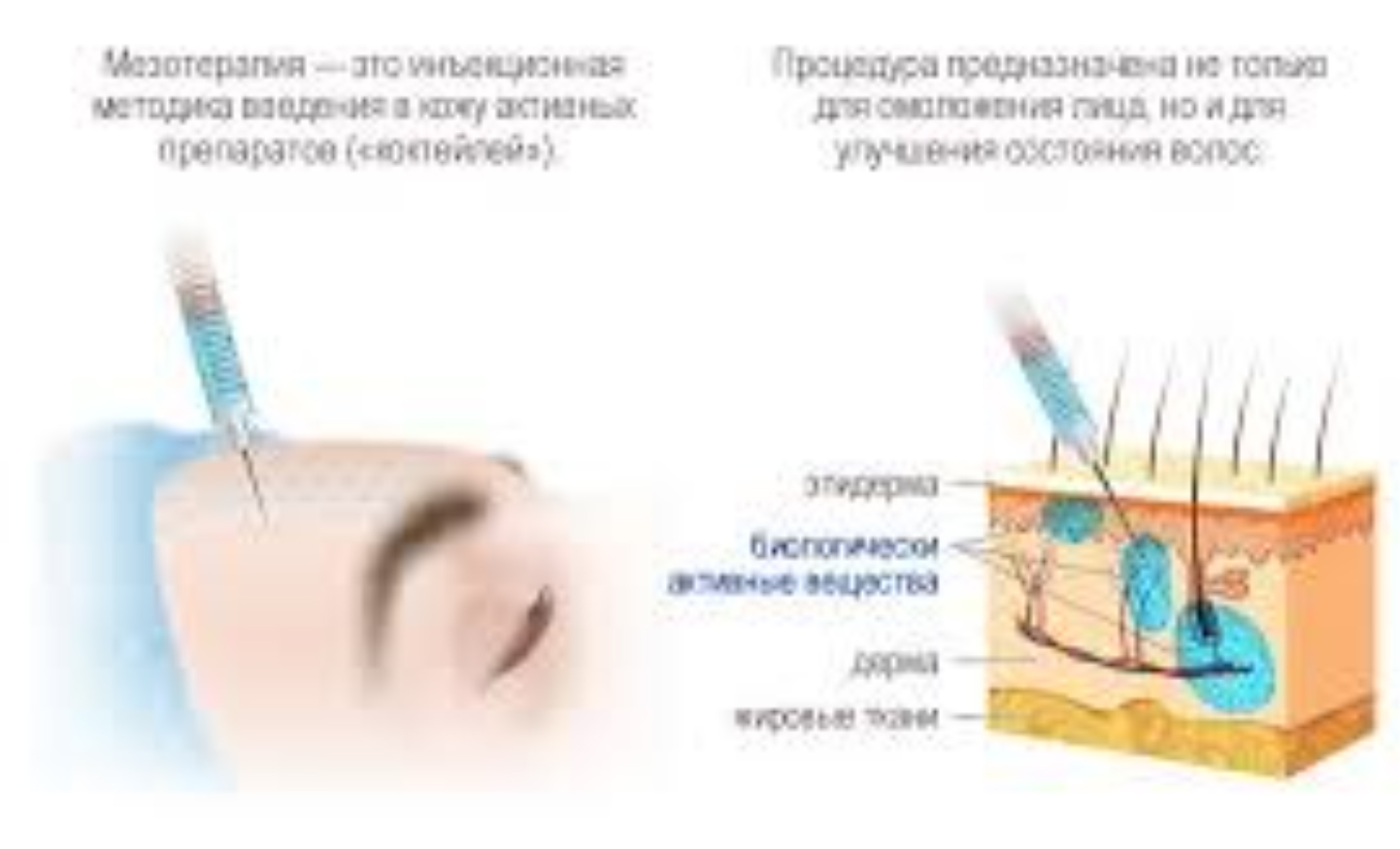 Мезотерапия для чего. Мезотерапия глаз что это за процедура. Мезотерапия для глаз игла. Optima Eye мезотерапия.