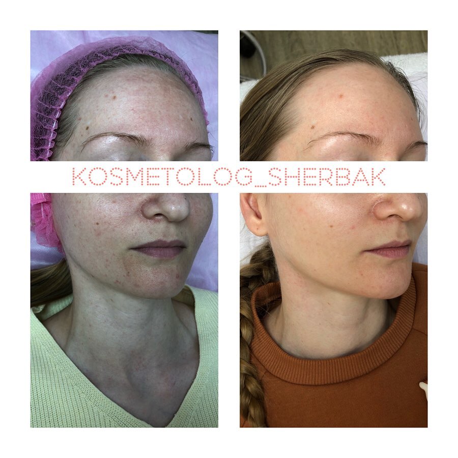 Индивидуальный подбор домашнего ухода в клинике PradusCOSMO, Санкт-Петербург. Косметологический анализ кожи и рекомендация профессиональной косметики