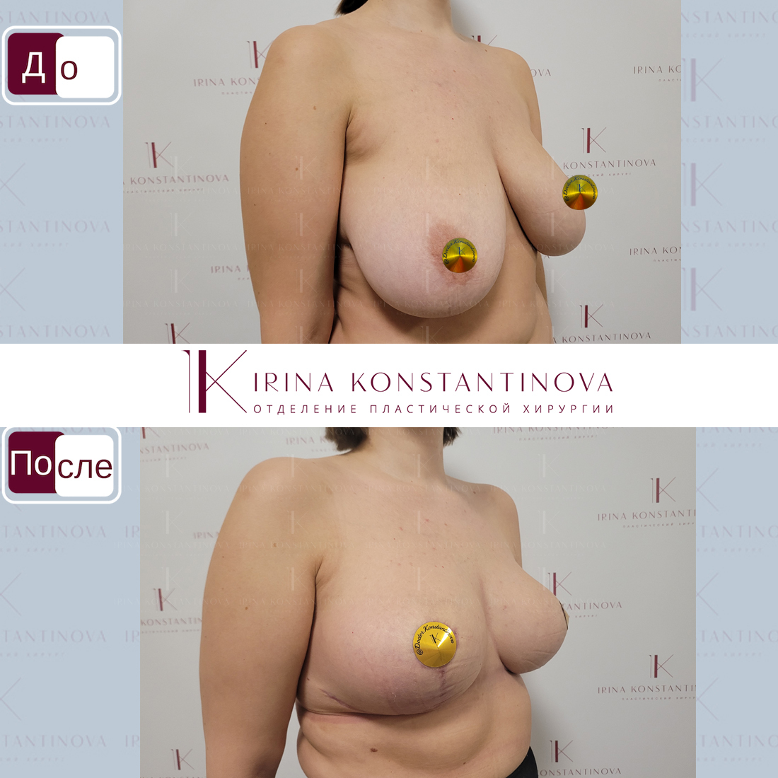 операция по уменьшения размера груди фото 36