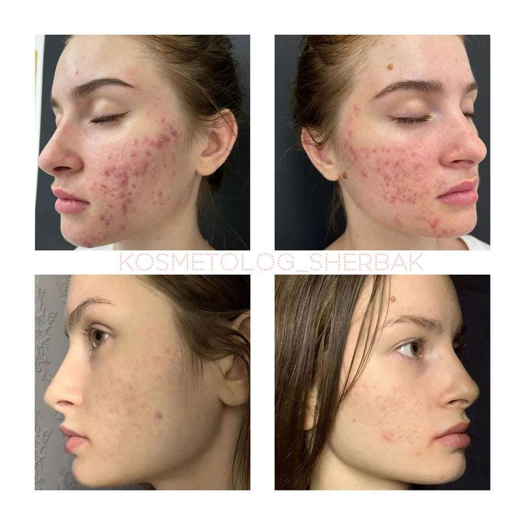 Лечение акне у женщины в клинике PradusCOSMO, СПб. До и после процедуры