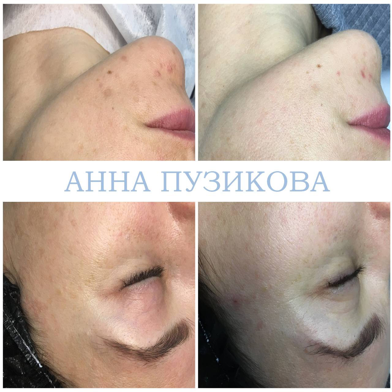 Результат удаления пигментных пятен после курса фототерапии ClearLight IPL — врач-косметолог Пузикова Анна Анатольевна, Санкт-Петербург