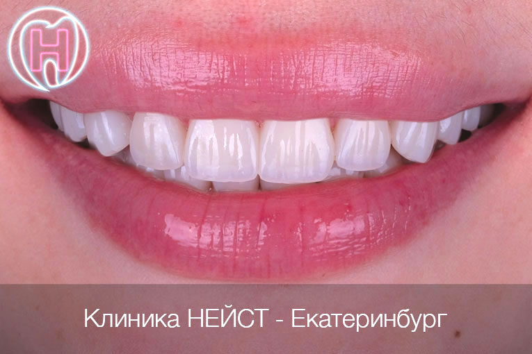 Авторские композитные виниры в Екатеринбурге, цвет А1