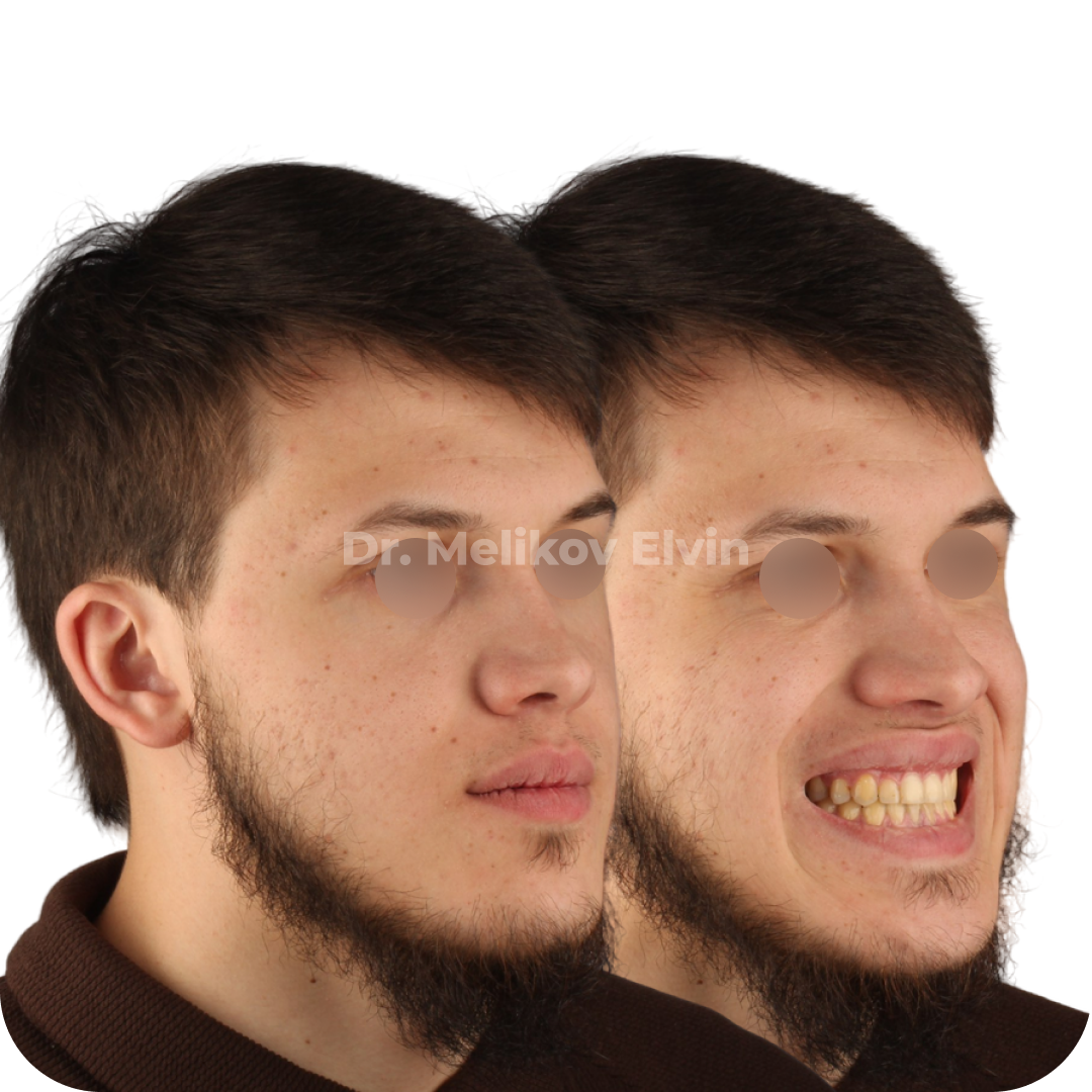 Фотографии до и после ортогнатической операции.